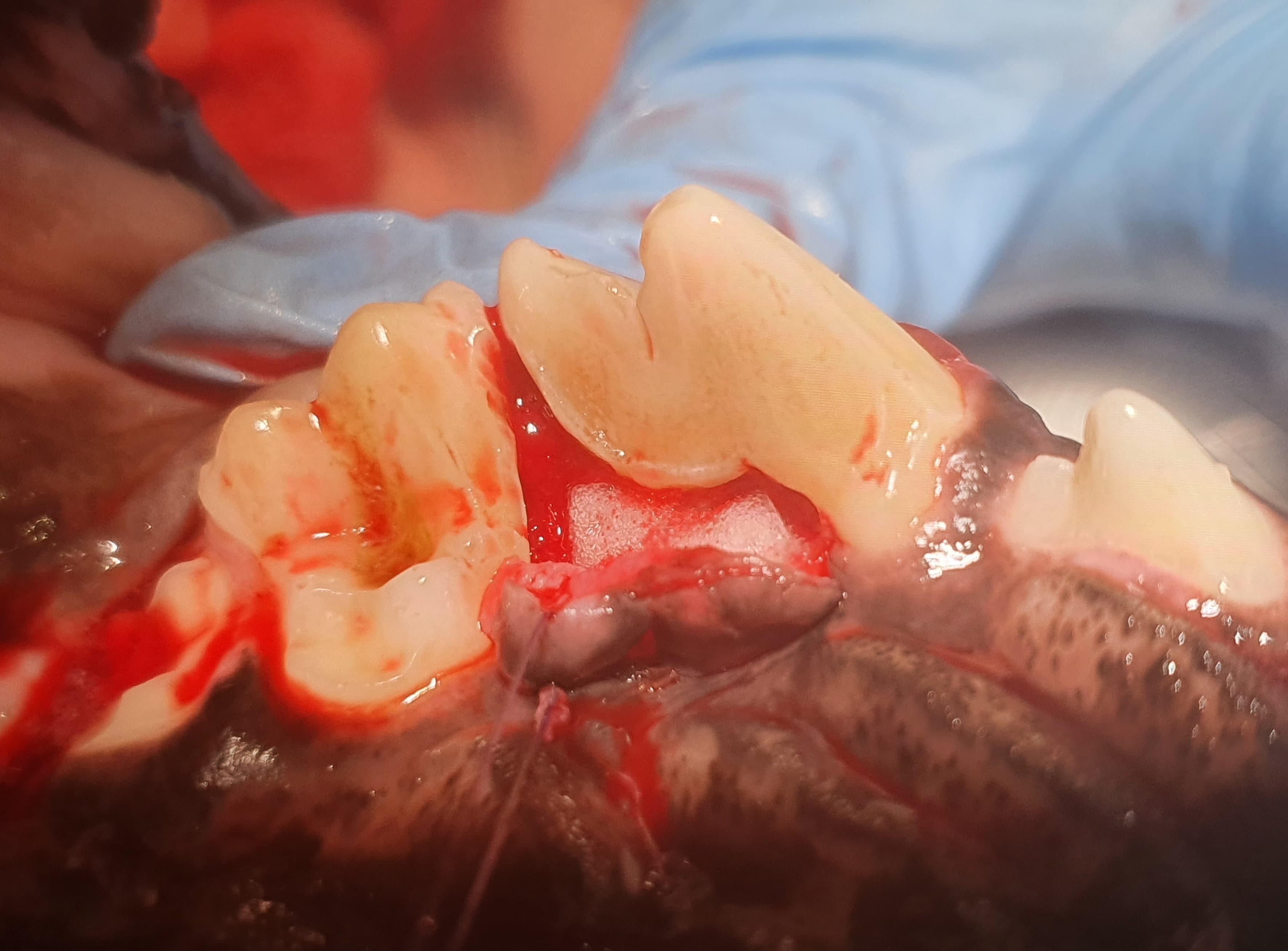 Leczenie periodontologiczne — sterowana regeneracja kości — Po