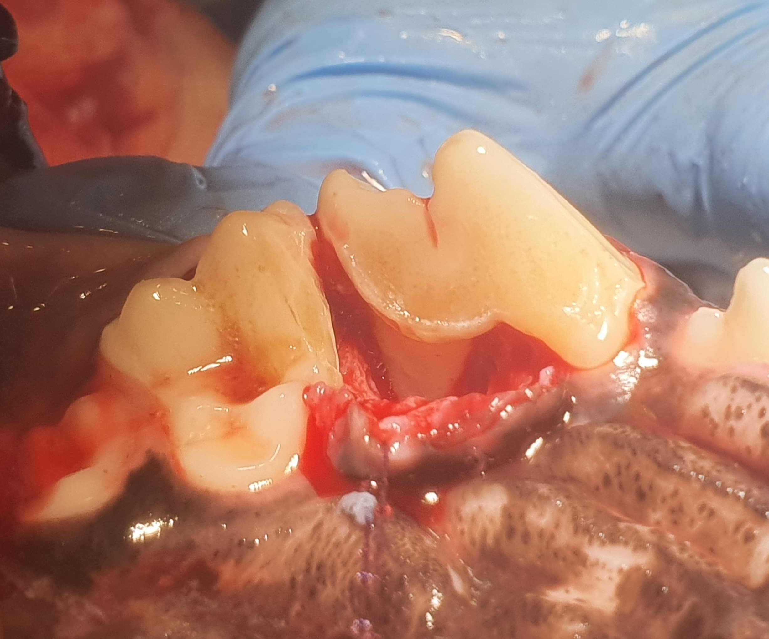 Leczenie periodontologiczne — sterowana regeneracja kości — Przed